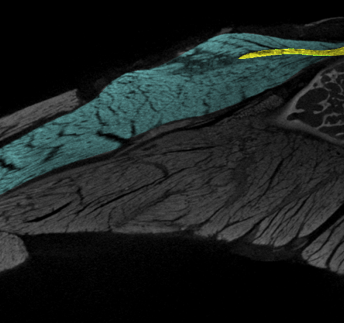 Uni Michigan CT Muscle Scan.png